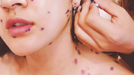 Bệnh thủy đậu ở người lớn nguy hiểm như thế nào?