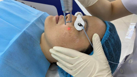 Top 5 công nghệ trị nám hiệu quả nhất hiện nay