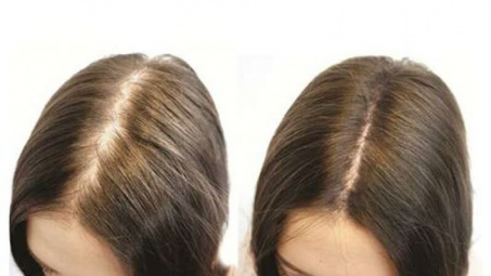 Kích thích tóc mọc nhanh bằng các biện pháp đơn giản tại nhà