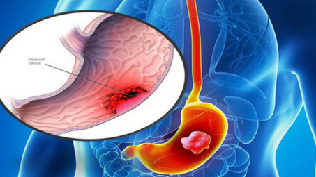 Chuyên gia khuyến cáo "thủ phạm" có thể gây ung thư dạ dày người Việt hay mắc 