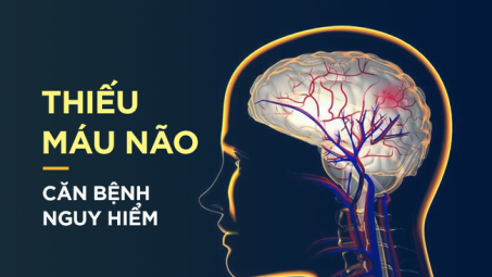 Dấu hiệu điển hình của bệnh thiếu máu não: Hãy cảnh giác sớm để tránh bị đột quỵ bất ngờ 