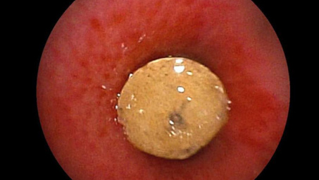 Bé trai bị nghẽn đường thở do sặc hạt nhựa