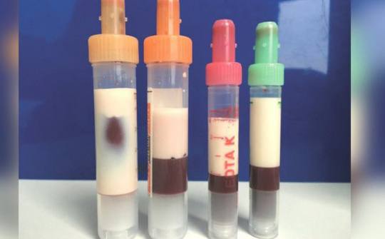 Kì diệu: Cứu sống một bệnh nhân Đức có máu trắng như sữa