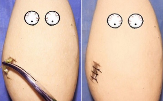 Gặp gỡ vị bác sỹ Trung Quốc chuyên phẫu thuật cho trái cây để nâng cao nhận thức về phẫu thuật cho cộng đồng