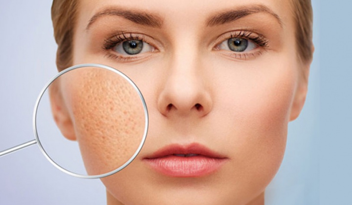 Vì sao có tình trạng lỗ chân lông to?