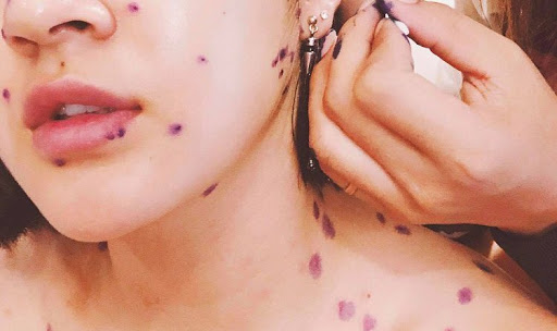 Bệnh thủy đậu ở người lớn nguy hiểm như thế nào?