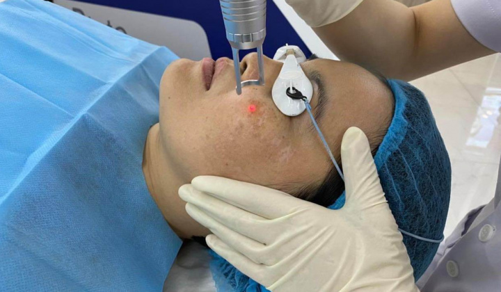 Top 5 công nghệ trị nám hiệu quả nhất hiện nay