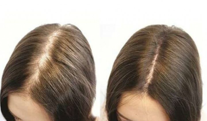 Kích thích tóc mọc nhanh bằng các biện pháp đơn giản tại nhà